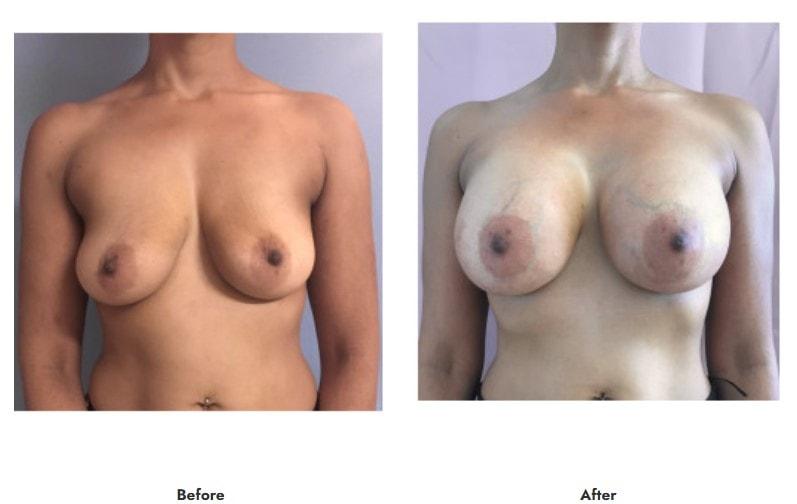 Pasadena Surgeons breast augmentation result โ Pasadena, CA