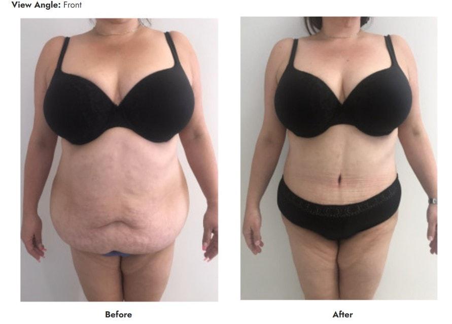 Pasadena Surgeons tummy tuck result — Pasadena, CA