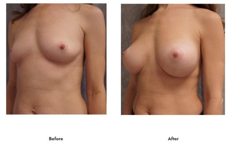 Pasadena Surgeons breast augmentation result — Pasadena, CA