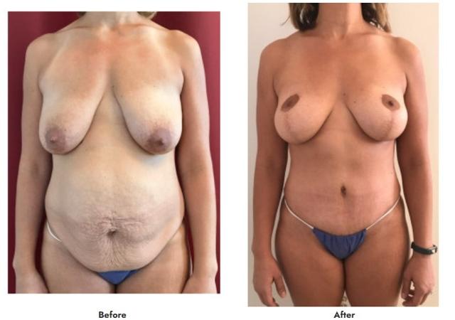 Mommy Makeover result at Pasadena Surgeons in Pasadena, CA