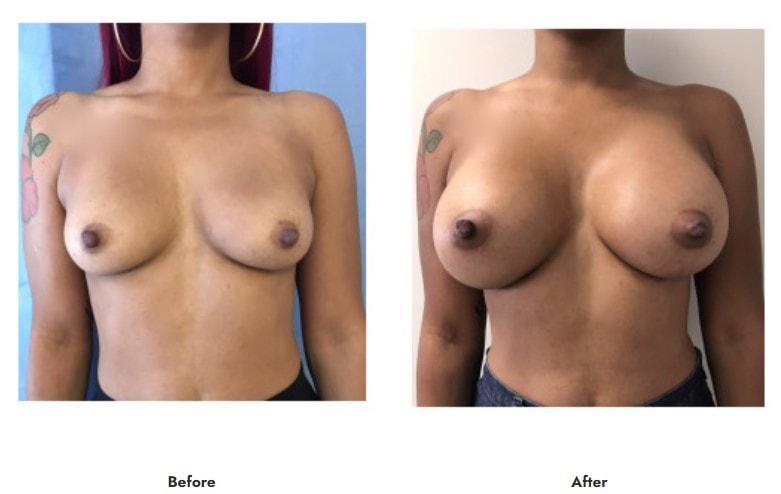 Pasadena Surgeons breast augmentation result — Pasadena, CA