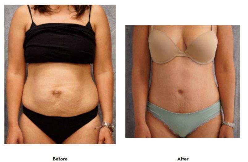 Pasadena Surgeons tummy tuck result โ Pasadena, CA