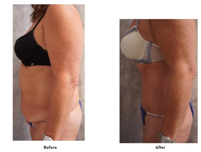 Pasadena Surgeons tummy tuck result โ Pasadena, CA