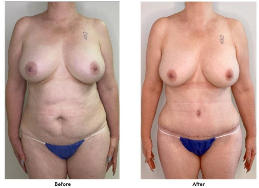 Pasadena Surgeons tummy tuck result — Pasadena, CA