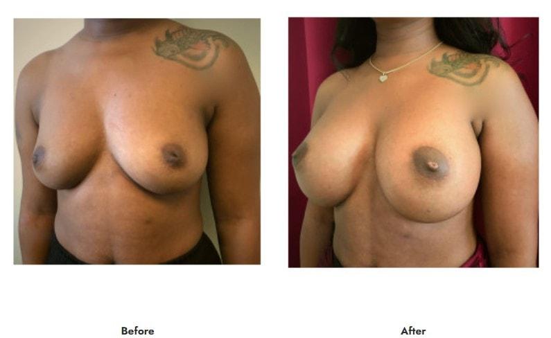 Pasadena Surgeons breast augmentation result — Pasadena, CA