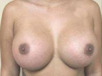 Breast Augmentation after at Shumway Cosmetic Surgery in San Diego, CA