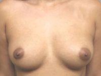 Breast Augmentation before at Shumway Cosmetic Surgery in San Diego, CA