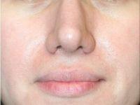 Shumway Cosmetic Surgery after — San Diego, CA