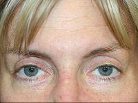 Blepharoplasty after at Shumway Cosmetic Surgery in San Diego, CA