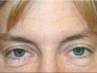 Blepharoplasty before at Shumway Cosmetic Surgery in San Diego, CA