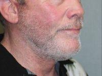 Shumway Cosmetic Surgery facelift after — San Diego, CA