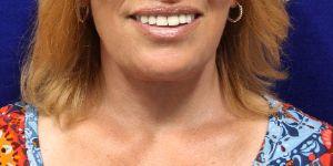 Shumway Cosmetic Surgery after — San Diego, CA