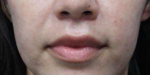 Lip Filler after at Shumway Cosmetic Surgery in San Diego, CA