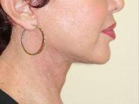 Shumway Cosmetic Surgery facelift after — San Diego, CA