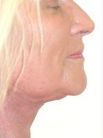 Shumway Cosmetic Surgery facelift after — San Diego, CA
