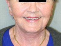 Neck Lift after at Shumway Cosmetic Surgery in San Diego, CA
