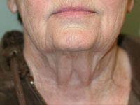 Neck Lift before at Shumway Cosmetic Surgery in San Diego, CA