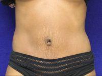 Mini Tummy Tuck after at Shumway Cosmetic Surgery in San Diego, CA