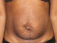Mini Tummy Tuck before at Shumway Cosmetic Surgery in San Diego, CA