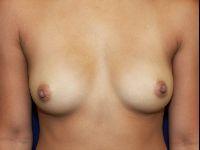 Breast Augmentation before at Shumway Cosmetic Surgery in San Diego, CA