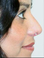 Rhinoplasty after at Shumway Cosmetic Surgery in San Diego, CA