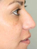 Rhinoplasty before at Shumway Cosmetic Surgery in San Diego, CA