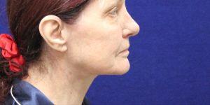 Shumway Cosmetic Surgery after — San Diego, CA