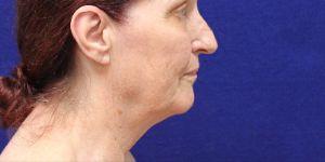 Facelift before at Shumway Cosmetic Surgery in San Diego, CA