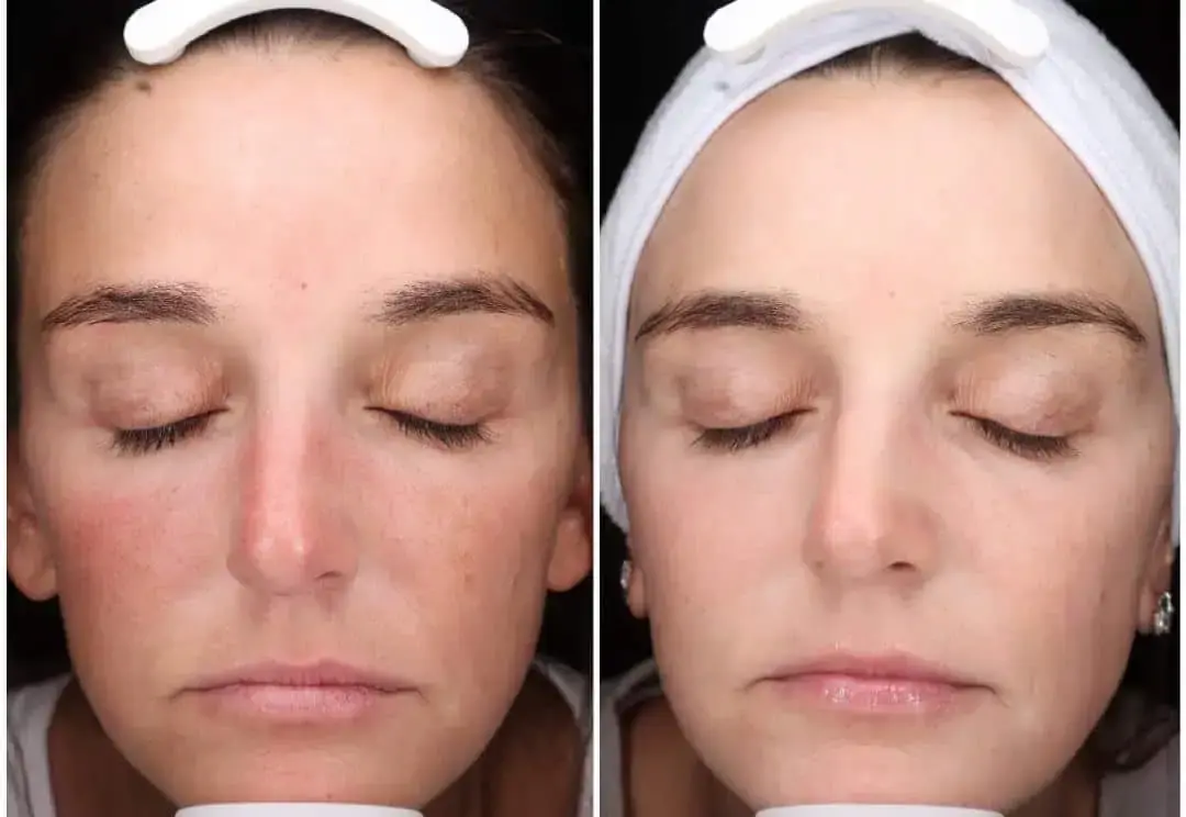 MediMorph photofacial result — Crescent Springs, KY