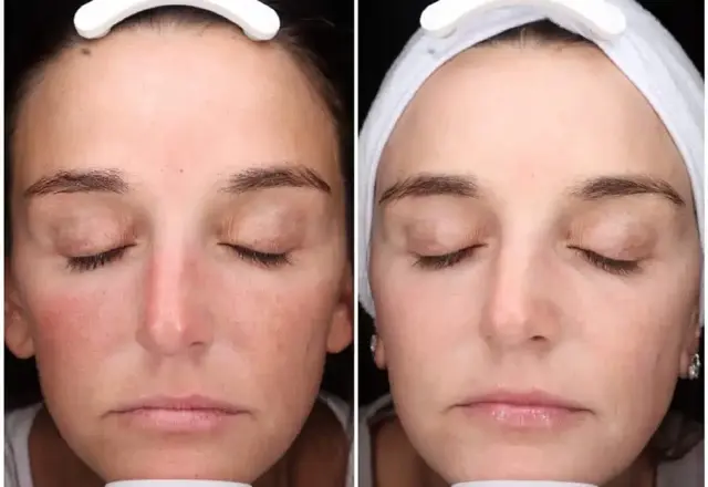 Laser Skin Resurfacing result at MediMorph in Crescent Springs, KY