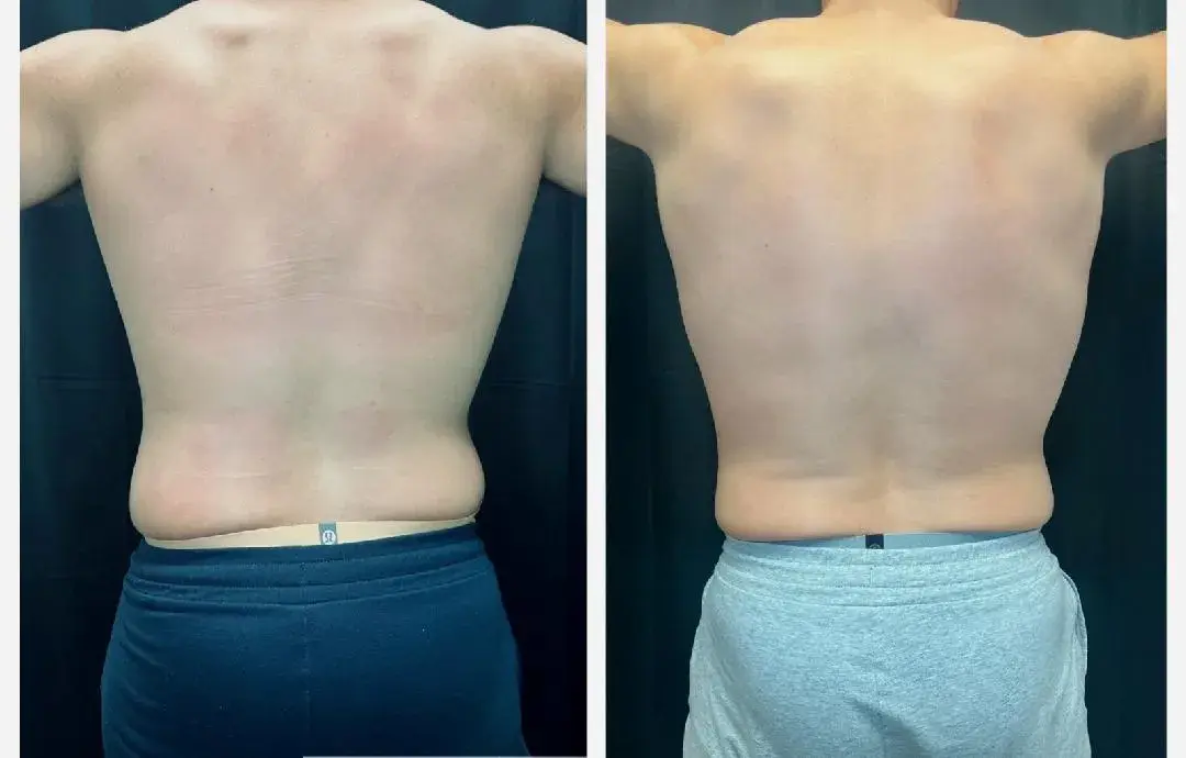 MediMorph coolsculpting result — Crescent Springs, KY