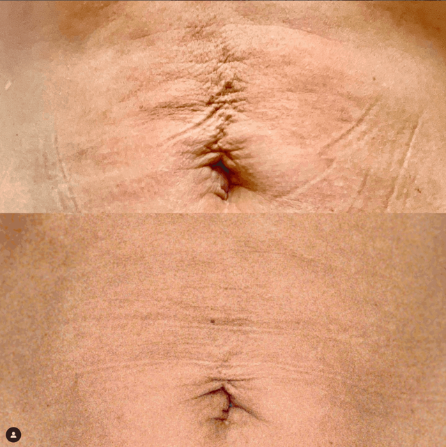 Laser Skin Resurfacing result at MediMorph in Crescent Springs, KY