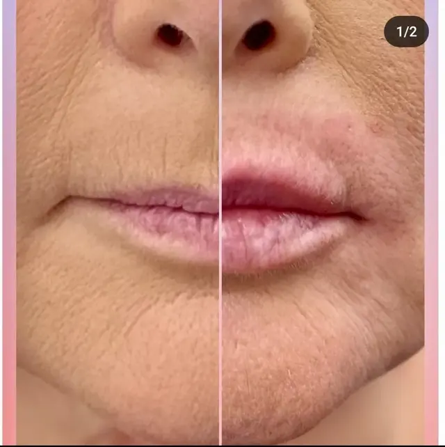 Lip Filler result at MediMorph in Crescent Springs, KY