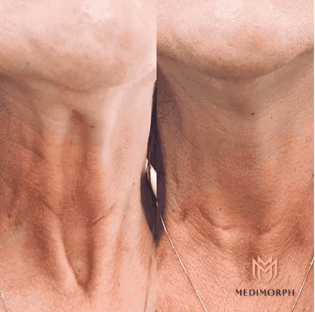 Botox result at MediMorph in Crescent Springs, KY
