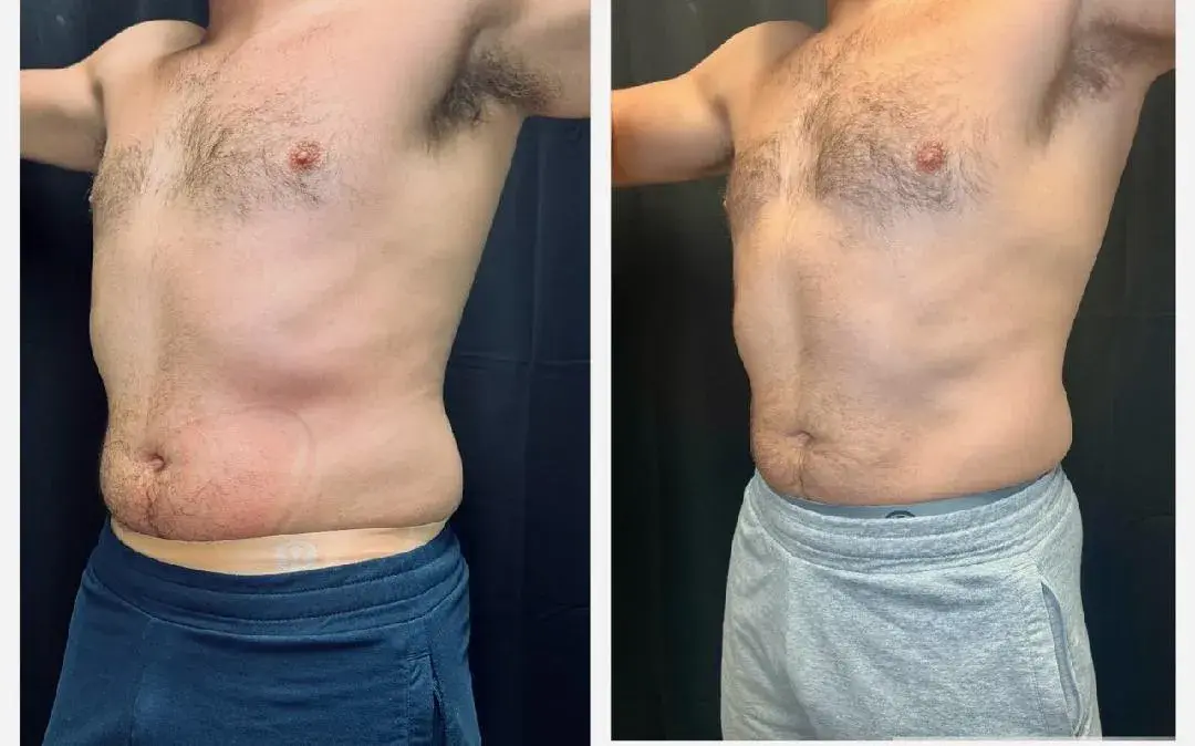 MediMorph coolsculpting result — Crescent Springs, KY