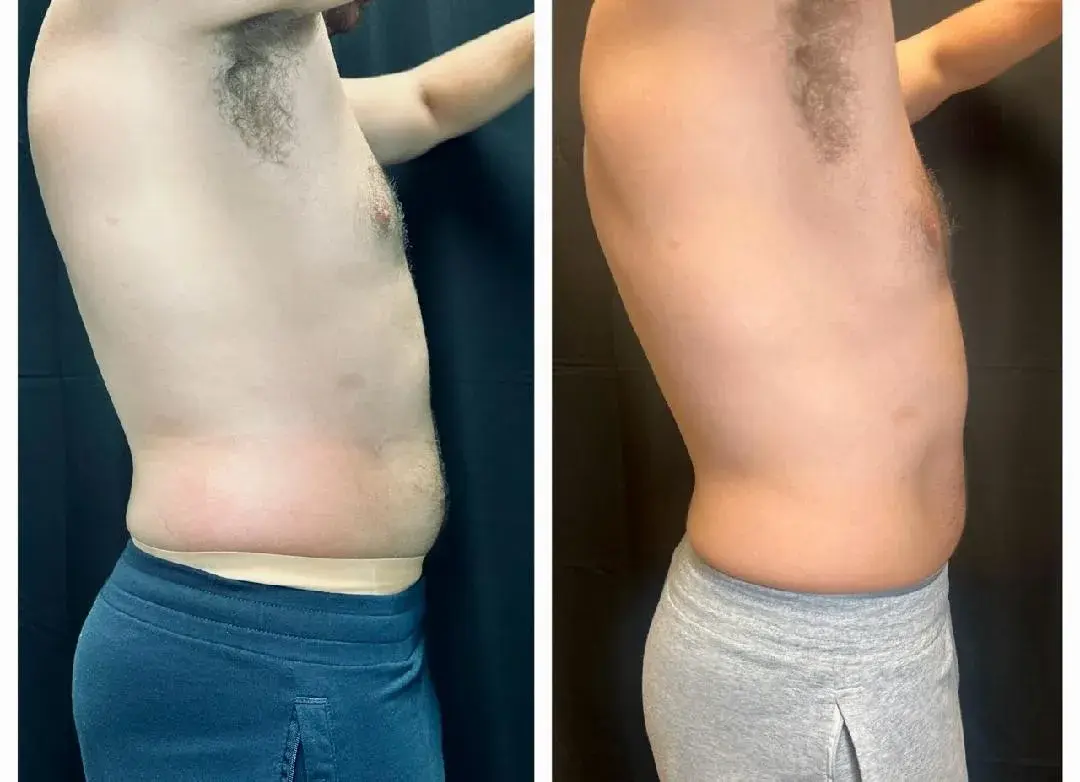 MediMorph coolsculpting result — Crescent Springs, KY