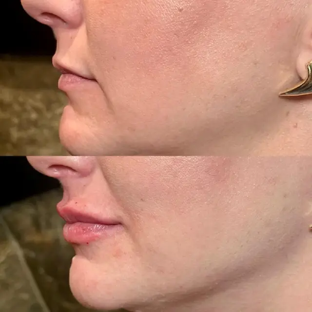 Lip Filler result at MediMorph in Crescent Springs, KY