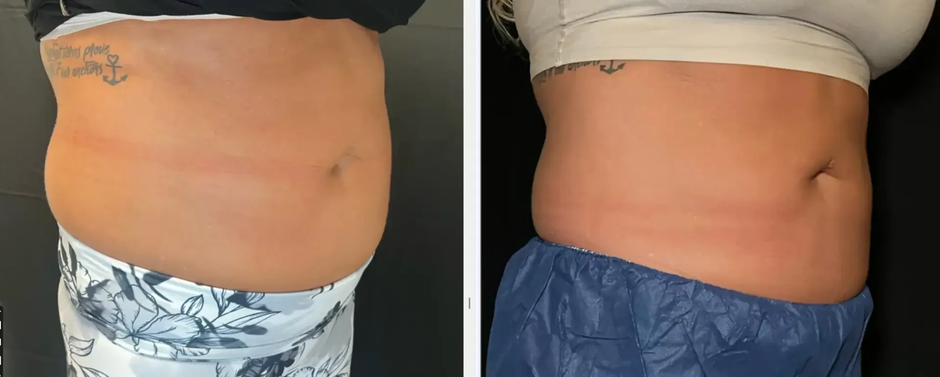 MediMorph body contouring result — Crescent Springs, KY