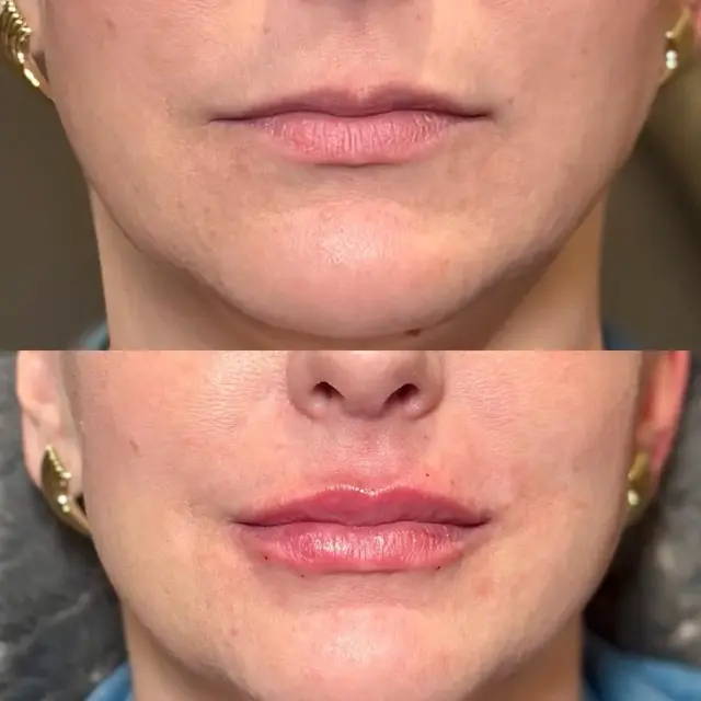Lip Filler result at MediMorph in Crescent Springs, KY