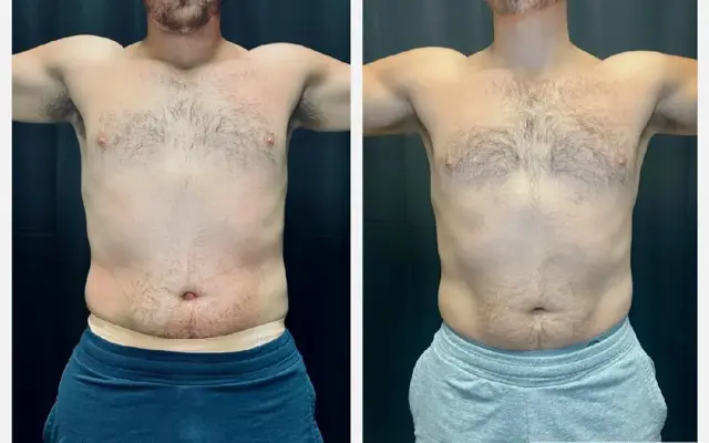 Thigh Lift result at MediMorph in Crescent Springs, KY