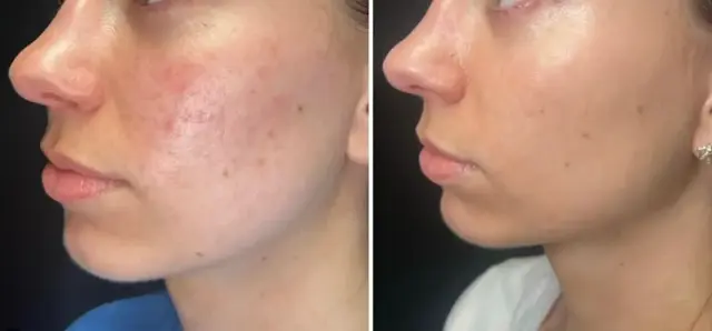 Laser Skin Resurfacing result at MediMorph in Crescent Springs, KY