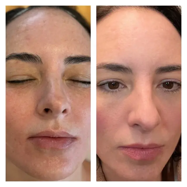 Laser Skin Resurfacing result at Novu Wellness & Aesthetics in Draper, UT