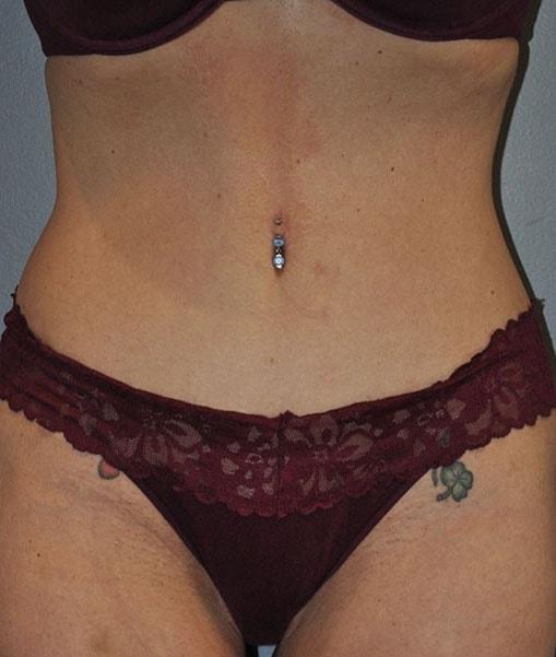 Paydar Plastic Surgery: Keyian Z Paydar, MD tummy tuck after — Newport Beach, CA