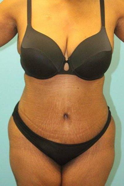 Paydar Plastic Surgery: Keyian Z Paydar, MD tummy tuck after — Newport Beach, CA