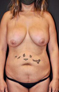Tummy Tuck before at Paydar Plastic Surgery: Keyian Z Paydar, MD in Newport Beach, CA