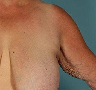 Arm Lift before at Paydar Plastic Surgery: Keyian Z Paydar, MD in Newport Beach, CA