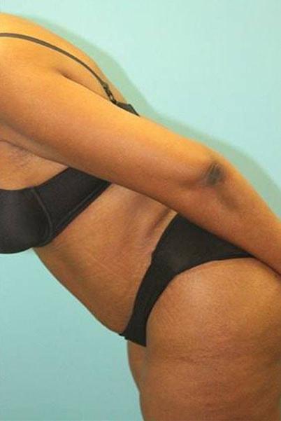 Mini Tummy Tuck after at Paydar Plastic Surgery: Keyian Z Paydar, MD in Newport Beach, CA