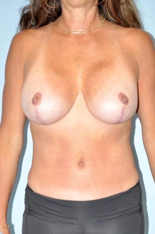 Paydar Plastic Surgery: Keyian Z Paydar, MD mommy makeover after — Newport Beach, CA