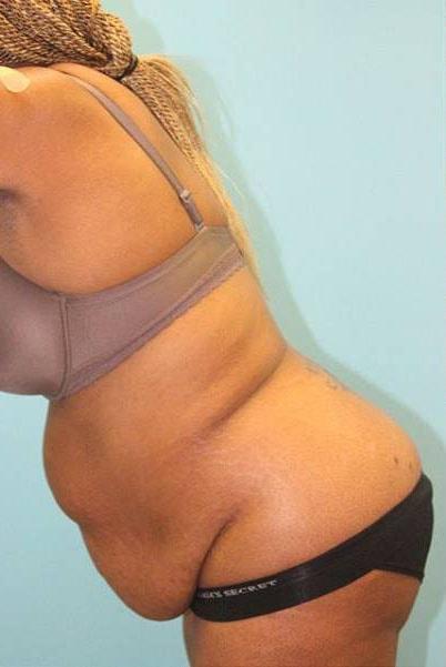 Mini Tummy Tuck before at Paydar Plastic Surgery: Keyian Z Paydar, MD in Newport Beach, CA