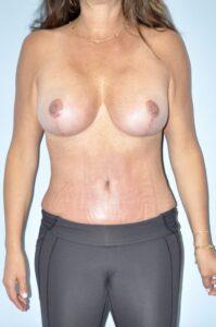 Tummy Tuck after at Paydar Plastic Surgery: Keyian Z Paydar, MD in Newport Beach, CA